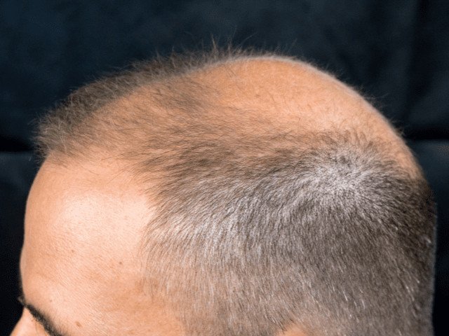 old man with bald spot thinning hair