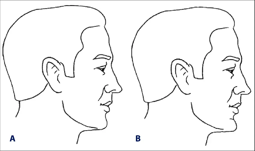 Chin Type-
Two different types of chin: normally prominent (A) or somewhat flatter chin and a type of prominent chin (B). 