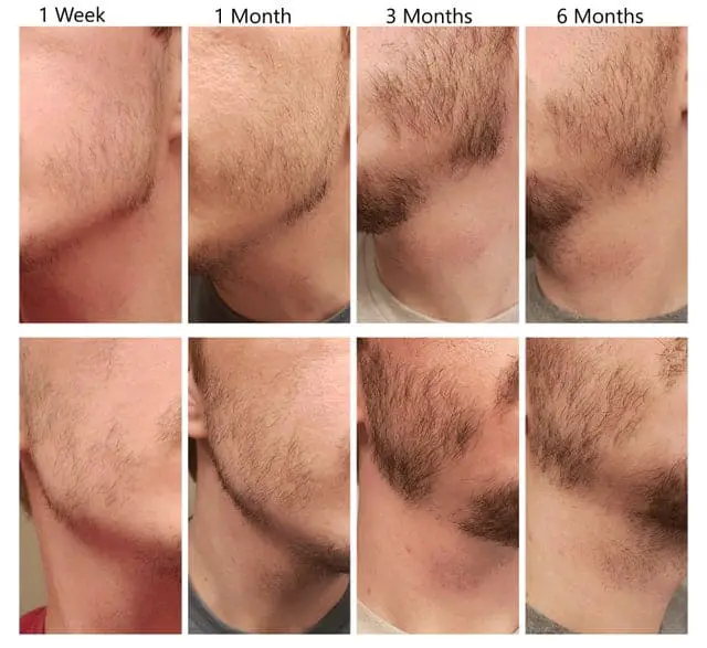 Growth Pattern of Your Facial Hair