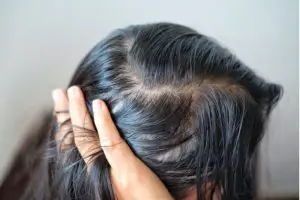 Damaged Hair and Scalp Problems
